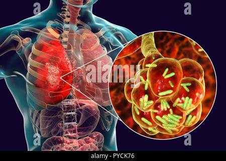 La pneumonie bactérienne. Illustration d'ordinateur de bactéries en forme de bâtonnet (bacilles) dans les alvéoles des poumons, causant une infection des voies respiratoires inférieures. C'est plus généralement connue sous le nom de pneumonie, si ce terme peut également être réservés pour des types spécifiques de l'infection. De graves infections pulmonaires sont diagnostiqués par X-ray et traitées par antibiotiques. Les alvéoles sont le site d'échanges gazeux entre l'air dans les poumons et dans le sang. Banque D'Images
