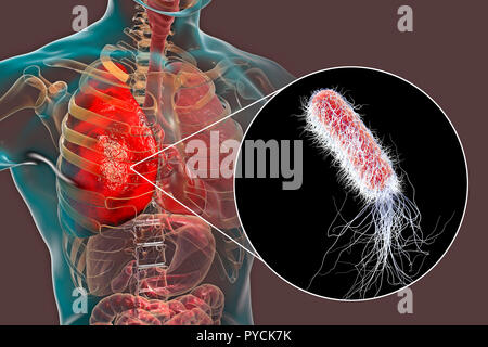 La pneumonie causée par les bactéries Pseudomonas aeruginosa, illustration de l'ordinateur. P. aeruginosa est une bactérie à Gram négatif qui cause de multiples infections nosocomiales résistantes aux antibiotiques (les) infections des autre emplacement, y compris la pneumonie, ostéomyélite, une péritonite et infections de plaies. Banque D'Images