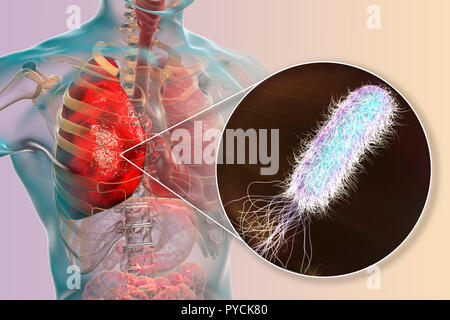 La pneumonie causée par les bactéries Pseudomonas aeruginosa, illustration de l'ordinateur. P. aeruginosa est une bactérie à Gram négatif qui cause de multiples infections nosocomiales résistantes aux antibiotiques (les) infections des autre emplacement, y compris la pneumonie, ostéomyélite, une péritonite et infections de plaies. Banque D'Images