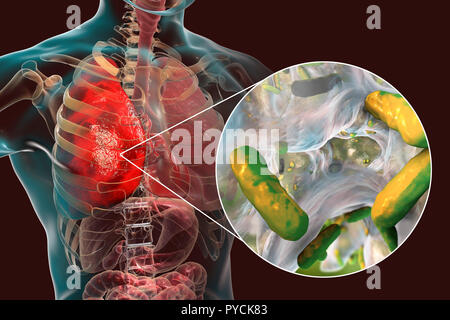 La pneumonie causée par les bactéries Pseudomonas aeruginosa, illustration de l'ordinateur. P. aeruginosa est une bactérie à Gram négatif qui cause de multiples infections nosocomiales résistantes aux antibiotiques (les) infections des autre emplacement, y compris la pneumonie, ostéomyélite, une péritonite et infections de plaies. Banque D'Images