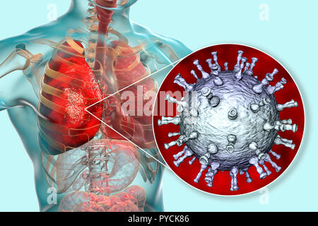 La pneumonie causée par le virus varicelle-zona (VZV), illustration de l'ordinateur. Le VZV n'est un virus de la famille des Herpesviridae, l'agent causal de la varicelle et le zona. Dans les cas graves peuvent causer des complications VZV, telles que la pneumonie et l'encéphalite. Banque D'Images