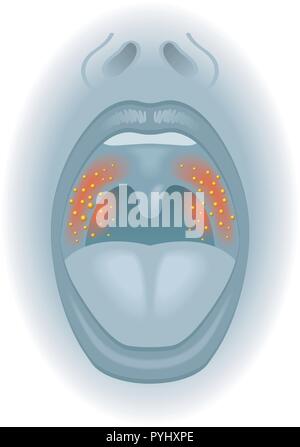 Medical illustration des effets des maux de gorge Illustration de Vecteur