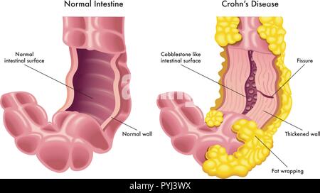 Un vecteur illustration médicale d'une section d'un intestin normal par rapport à une section de l'intestin avec les symptômes de la maladie de Crohn. Illustration de Vecteur