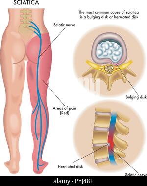 Symptômes de illustration médicale de sciatique Illustration de Vecteur