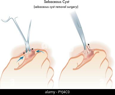 Illustration médicale de la chirurgie de déplacement de Kyste sébacé Illustration de Vecteur