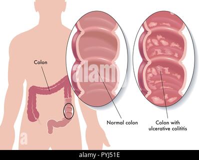 Illustration des effets médicaux de la colite ulcéreuse Illustration de Vecteur