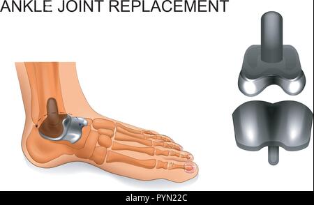 Illustration vecteur de remplacement de la cheville de skeleton. Illustration de Vecteur