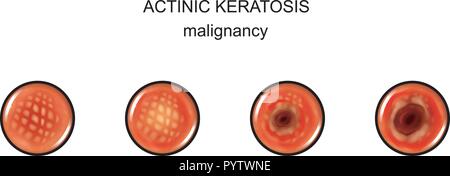 Vector illustration de la kératose actinique. malignization cancer. Illustration de Vecteur