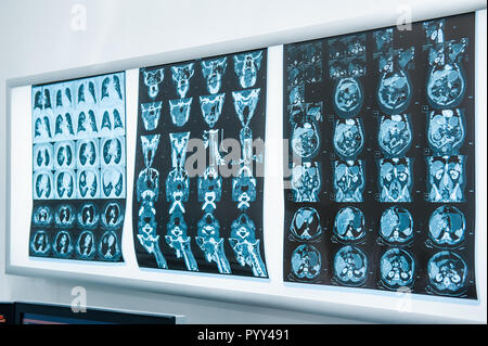 Plusieurs d'imagerie par résonance magnétique (IRM) du cerveau. Selective focus Banque D'Images