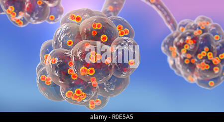 La pneumonie staphylococcique. Illustration d'ordinateur des Staphylococcus aureus dans les alvéoles des poumons et causer une pneumonie. Banque D'Images