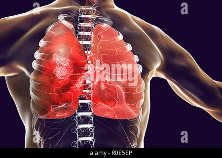 La pneumonie, l'illustration. La pneumonie est une maladie inflammatoire des poumons. Banque D'Images