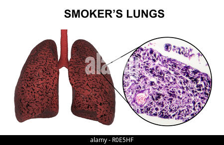 Les poumons du fumeur, illustration de l'ordinateur et la lumière microphotographie. Banque D'Images