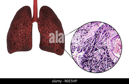 Les poumons du fumeur, illustration de l'ordinateur et la lumière microphotographie. Banque D'Images