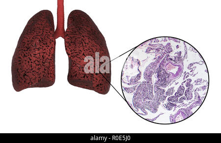 Les poumons du fumeur, illustration de l'ordinateur et la lumière microphotographie. Banque D'Images