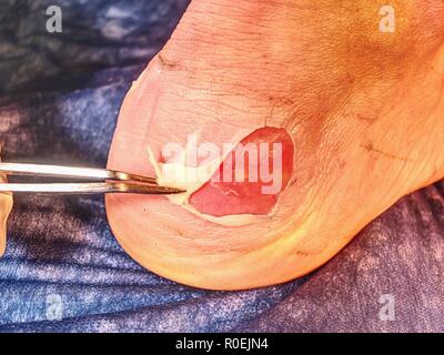 Nettoyage infirmière peaux mortes sur la jambe du patient avec spike, ciseaux stériles bleu arrière-plan. Rayures profondes sur la peau avec des ecchymoses et des traces humides Banque D'Images