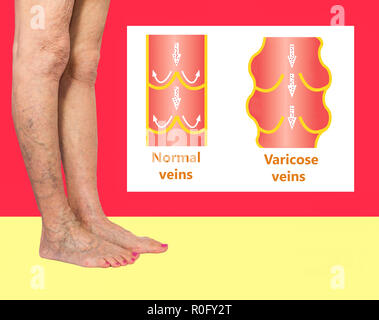 Varices sur les jambes d'une femme senior. La structure de la normale et varices Banque D'Images