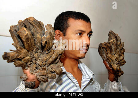 Dhaka, Bangladesh - 02 Février 2016 : l'homme Bajadar Abul Bangladais, 25 ans, s'assied sur son mauvais dans un hôpital à Dhaka, au Bangladesh. Bajadar a été souffrance Banque D'Images