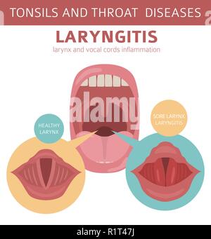 Amygdales et de la gorge. Les symptômes de la laryngite, l'icône de traitement défini. Conception infographique médical. Vector illustration Illustration de Vecteur