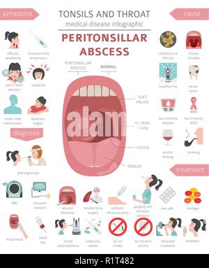 Amygdales et de la gorge. Abcès périamygdalien symptômes, traitement icon set. Conception infographique médical. Vector illustration Illustration de Vecteur