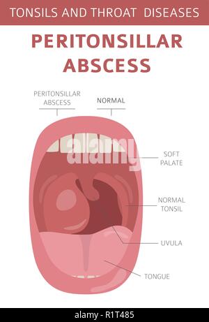 Amygdales et de la gorge. Abcès périamygdalien symptômes, traitement icon set. Conception infographique médical. Vector illustration Illustration de Vecteur