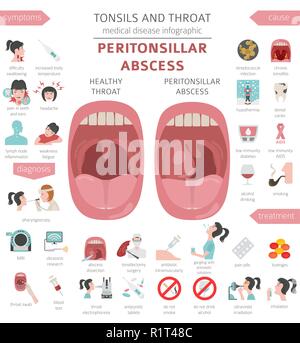 Amygdales et de la gorge. Abcès périamygdalien symptômes, traitement icon set. Conception infographique médical. Vector illustration Illustration de Vecteur