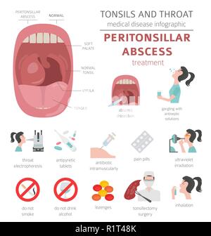 Amygdales et de la gorge. Abcès périamygdalien symptômes, traitement icon set. Conception infographique médical. Vector illustration Illustration de Vecteur