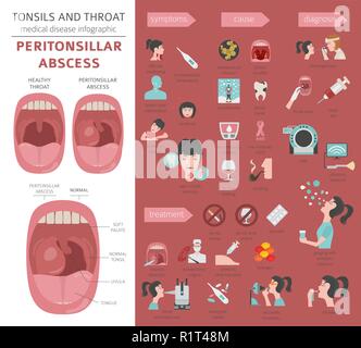 Amygdales et de la gorge. Abcès périamygdalien symptômes, traitement icon set. Conception infographique médical. Vector illustration Illustration de Vecteur