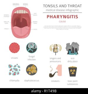 Amygdales et de la gorge. Les symptômes de la pharyngite, icône de traitement défini. Conception infographique médical. Vector illustration Illustration de Vecteur