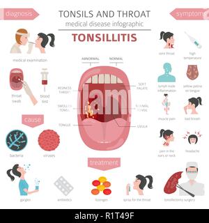 Amygdales et de la gorge. Les symptômes de l'amygdalite, icône de traitement défini. Conception infographique médical. Vector illustration Illustration de Vecteur