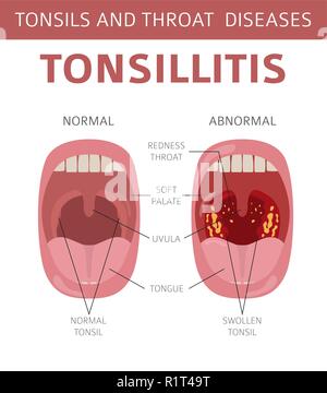 Amygdales et de la gorge. Les symptômes de l'amygdalite, icône de traitement défini. Conception infographique médical. Vector illustration Illustration de Vecteur