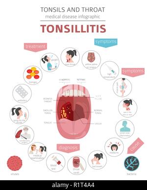 Amygdales et de la gorge. Les symptômes de l'amygdalite, icône de traitement défini. Conception infographique médical. Vector illustration Illustration de Vecteur