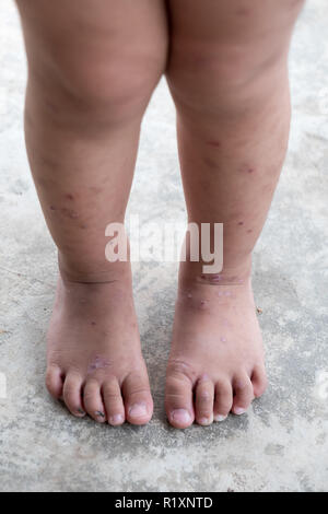 La dermatite prurigineuse bébé atopique pied. Close up.plaies infectées plaie ouverte à la jambe gauche. Banque D'Images