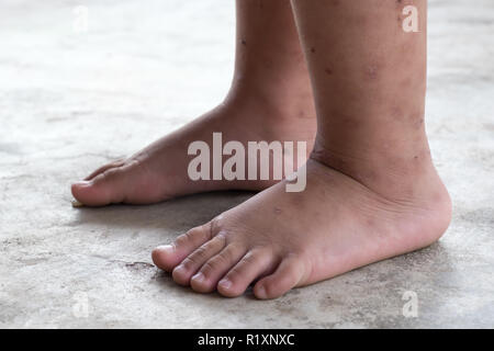 La dermatite prurigineuse bébé atopique pied. Close up.plaies infectées plaie ouverte à la jambe gauche. Banque D'Images