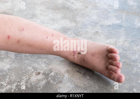 La dermatite prurigineuse bébé atopique pied. Close up.plaies infectées plaie ouverte à la jambe gauche. Banque D'Images