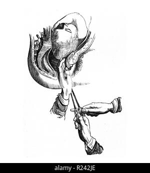 Une craniotomie. La perforation du crâne, l'enlèvement de matières, et d'extraction crânienne de la boîte crânienne. Banque D'Images