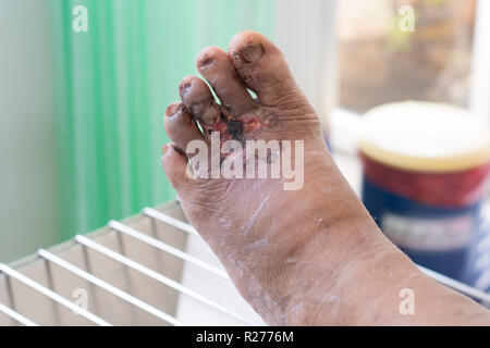 Plaies infectées du pied, de la plaie. Banque D'Images