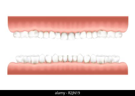 La dentition infographie graphique avec des dents humaines réalistes en gomme rose sur les mâchoires supérieures et inférieures sur blanc Illustration de Vecteur