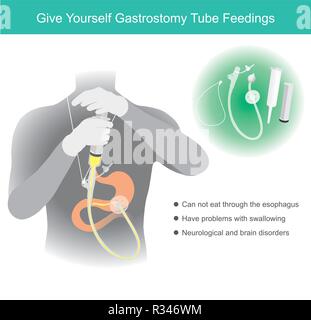 Utiliser un tube d'alimentation et ballon blocage du pêne en tant que périphérique inséré dans votre estomac à travers l'abdomen pour fournir les éléments nutritifs sur leur propre par seringue. Illustration de Vecteur