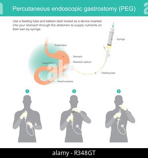 Utiliser un tube d'alimentation et ballon blocage du pêne en tant que périphérique inséré dans votre estomac à travers l'abdomen pour fournir les éléments nutritifs sur leur propre par seringue. Illustration de Vecteur