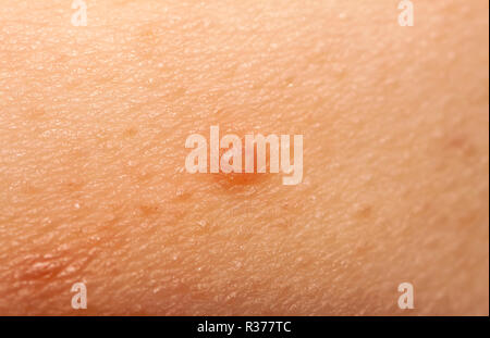 Close up de Molluscum Contagiosum aussi appelés verrues de l'eau. Banque D'Images