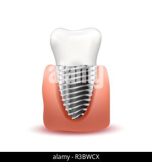 Implant métallique réaliste avec vis en gomme rose sur blanc Illustration de Vecteur