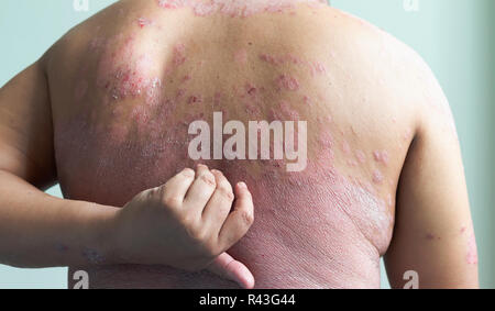 Les patients sont à l'aide de leurs propres mains, à l'éraflure eux-mêmes plein de lésions inflammatoires. Maladies causées par des anomalies de la lymphe. Le psoriasis est une Banque D'Images