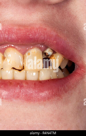 Les droits de l'tooth close-up pendant le traitement et de la prothèse avec des couronnes en céramique. Le concept de dentisterie Banque D'Images