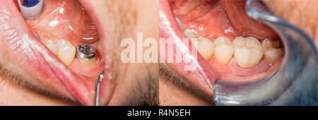 La couronne de la dent sur modèle en plâtre de la mâchoire. Macro close-up du processus de fabrication d'une couronne anatomique d'une dent. Le concept de restor dentaire Banque D'Images