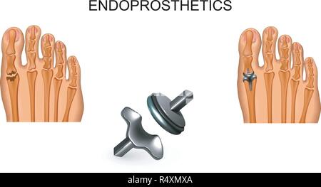 Vector illustration d'arthroplastie totale de la commune du gros orteil Illustration de Vecteur