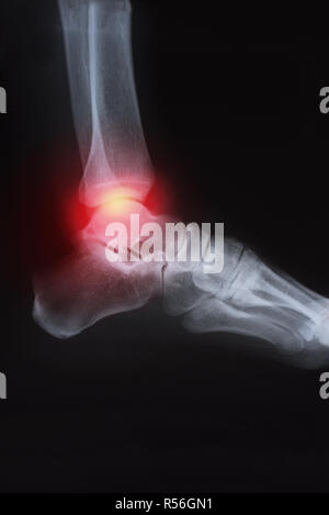 Medical x-ray articulation du genou droit avec l'arthrite ( la goutte, l'arthrite rhumatoïde, l'arthrite septique , l'arthrose du genou ) Banque D'Images
