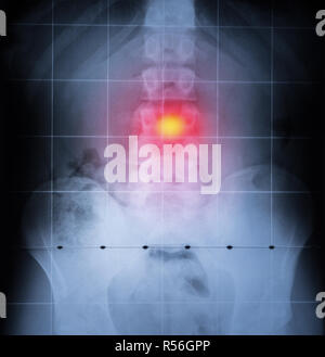 X ray, de la colonne vertébrale et du bassin du corps humain. Les maux de dos en rouge Banque D'Images