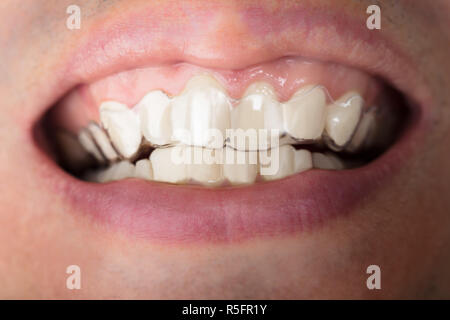 Homme portant des dents Aligners transparents Banque D'Images