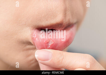 Femme souffrent de bouche aphtha Banque D'Images