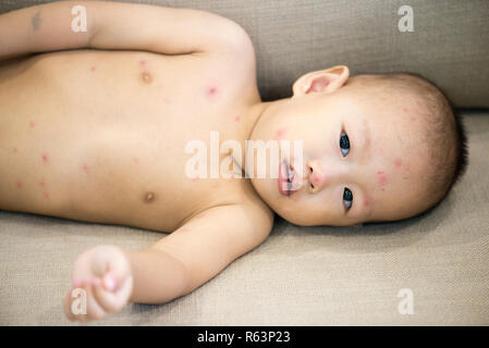 Baby Boy avec la varicelle lying on sofa Banque D'Images